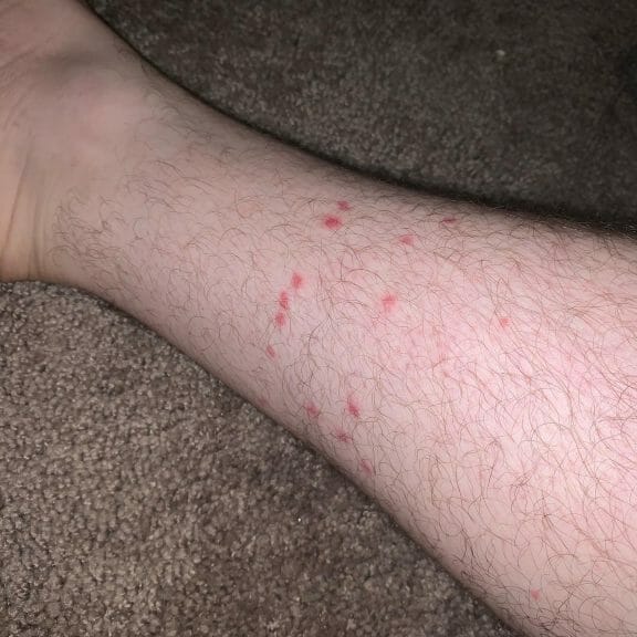 flea bites on human skin